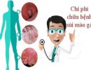 Chi phí chữa triệt để bệnh sùi mào gà