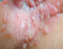 Bệnh Mào Gà Ở Phụ Nữ