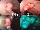 Bệnh Trĩ Nội Độ 2 Có Nguy Hiểm Không? Có Chữa Được Không?