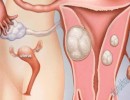 Tìm hiểu về bệnh u xơ tử cung