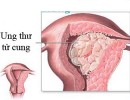 Ung thư tử cung - Bệnh ung thư đường sinh dục