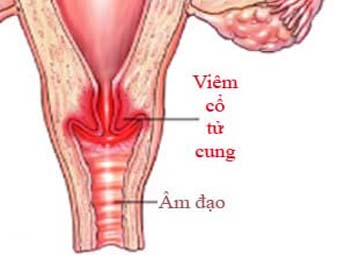 Hình ảnh viêm cổ tử cung