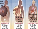 Giang mai là bệnh gì? Biểu hiện của bệnh giang mai ở nam nữ là gì?