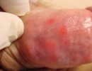 Hình Ảnh Bệnh Giang Mai Ở Bộ Phận Sinh Dục Và Cơ thể Nam Nữ