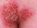 Biểu Hiện Mụn Rộp Sinh Dục Ở Giai Đoạn Đầu