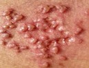 Hình Ảnh Bệnh Mụn Rộp Sinh Dục Nam Và Nữ Giới
