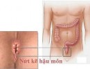 Nứt Kẽ Hậu Môn: Biểu Hiện Và Cách Điều Trị Nứt Hậu Môn