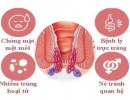 Bệnh Trĩ Ngoại Có Nguy Hiểm Không? Có Tự Hết Không?