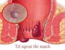 Trĩ Ngoại Tắc Mạch (Trĩ Ngoại Thuyên Tắc) Là Gì?