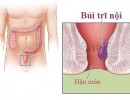 Bệnh Trĩ Nội Là Gì? Hình Ảnh và Cách Chữa
