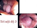 Bệnh Án Trĩ Nội Độ 3 Và Cách Điều Trị Trĩ Nội Độ 3