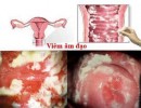 Viêm Âm Đạo: Hình Ảnh, Triệu Chứng Và Cách Chữa