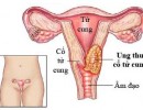Ung Thư Cổ Tử Cung – Bệnh ung thư đường sinh dục