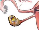 Tắc Vòi Trứng: Nguyên Nhân, Biểu Hiện và Cách Chữa