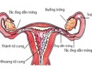 Tắc Vòi Trứng Có Kinh Nguyệt Không?