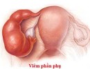 Những Điều Cần Biết Về Viêm Phần Phụ