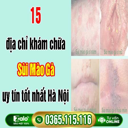 15 địa chỉ khám chữa Sùi Mào Gà [uy tín tốt nhất] Hà Nội