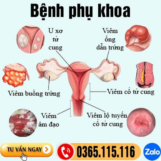 Các bệnh phụ khoa nguy hiểm và dấu hiệu thường gặp nhất