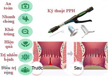 Cách điều trị nứt kẽ hậu môn Cách điều trị nứt kẽ hậu môn