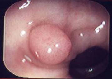 Hình ảnh bệnh polyp hậu môn Hình ảnh bệnh polyp hậu môn