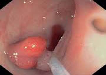 Hình ảnh bệnh polyp hậu môn Hình ảnh bệnh polyp hậu môn