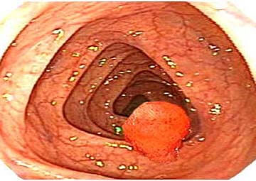 Hình ảnh bệnh polyp hậu môn Hình ảnh bệnh polyp hậu môn