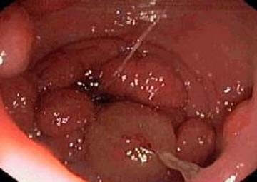 Hình ảnh bệnh polyp hậu môn ở trẻ em Hình ảnh bệnh polyp hậu môn ở trẻ em