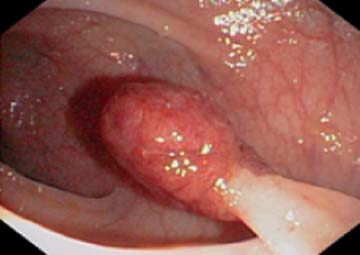Hình ảnh bệnh polyp hậu môn Hình ảnh bệnh polyp hậu môn