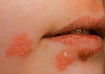 Biểu hiện mụn rộp sinh dục giai đoạn đầu Biểu hiện mụn rộp sinh dục giai đoạn đầu