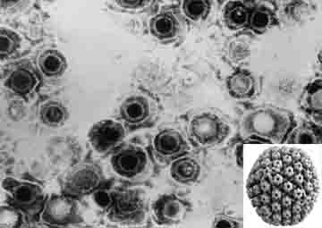 Hình ảnh virus Herpes simplex (HSV) Hình ảnh virus Herpes simplex (HSV)
