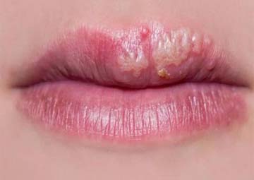 Hình ảnh mụn rộp sinh dục ở miệng Hình ảnh mụn rộp sinh dục ở miệng