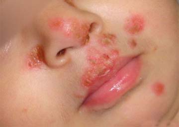 Hình ảnh mụn rộp sinh dục ở trẻ Hình ảnh mụn rộp sinh dục ở trẻ