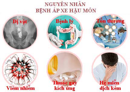 Nguyên nhân gây bệnh apxe hậu môn Nguyên nhân gây bệnh apxe hậu môn