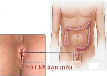 Nứt kẽ hậu môn - Bệnh nứt kẽ hậu môn Nứt kẽ hậu môn - Bệnh nứt kẽ hậu môn