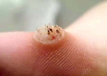 Hỏi đáp về bệnh sùi mào gà Hỏi đáp về bệnh sùi mào gà