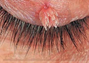 Sùi mào gà bao lâu thì phát bệnh Sùi mào gà bao lâu thì phát bệnh