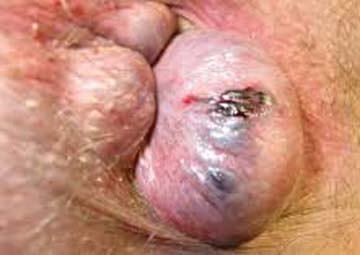 Hình ảnh trĩ ngoại Hình ảnh trĩ ngoại