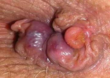 Hình ảnh trĩ ngoại Hình ảnh trĩ ngoại