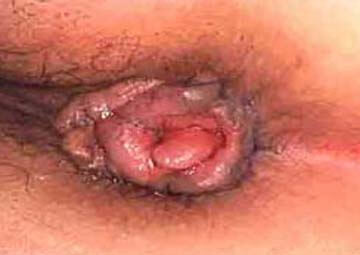 Hình ảnh trĩ ngoại Hình ảnh trĩ ngoại