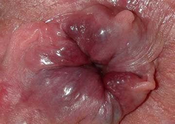 Hình ảnh trĩ ngoại Hình ảnh trĩ ngoại