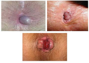 Hình ảnh trĩ ngoại Hình ảnh trĩ ngoại