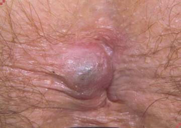 Hình ảnh trĩ ngoại độ 2 Hình ảnh trĩ ngoại độ 2