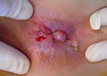 Hình ảnh trĩ ngoại Hình ảnh trĩ ngoại