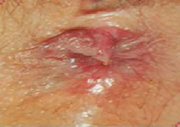 trĩ ngoại độ 2 trĩ ngoại độ 2