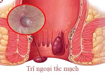 Trĩ ngoại tắc mạch