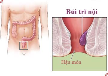 Bệnh trĩ nội Bệnh trĩ nội