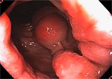 Hình ảnh trĩ nội độ 1