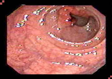 Hình ảnh trĩ nội độ 1 Hình ảnh trĩ nội độ 1