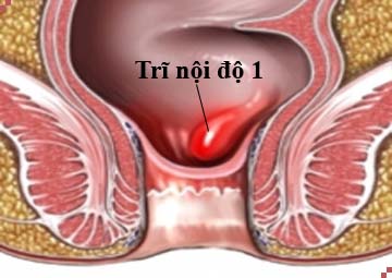 Bệnh Trĩ Nội Độ 2 Có Nguy Hiểm Không Có Chữa Được Không