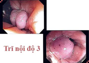 trĩ nội độ 3 trĩ nội độ 3